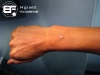 wrist-micro-dermal-09.jpg